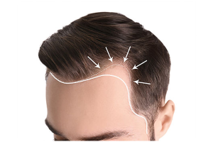 Force Hair Transplant de Par